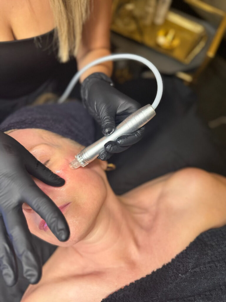 hydrafacial hydrodermabrasion hydroglow newport beach facial