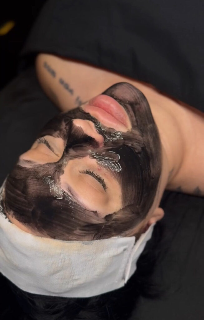 ACNE FACIAL COSTA MESA