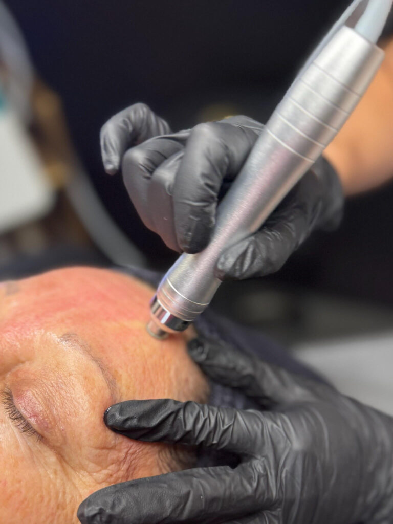 MICRODERMABRASION COSTA MESA