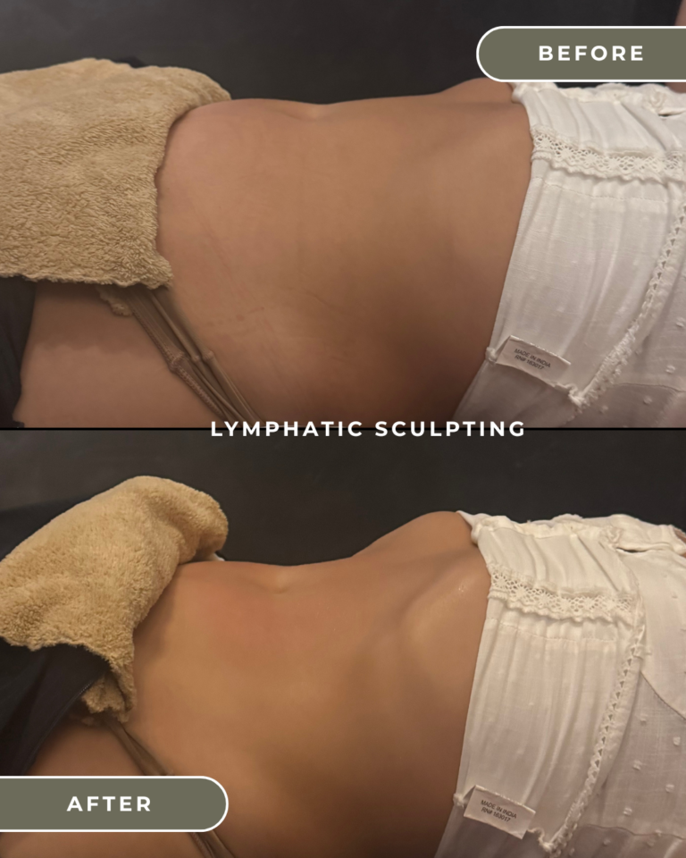 LYMPHATIC DRAINAGE COSTA MESA