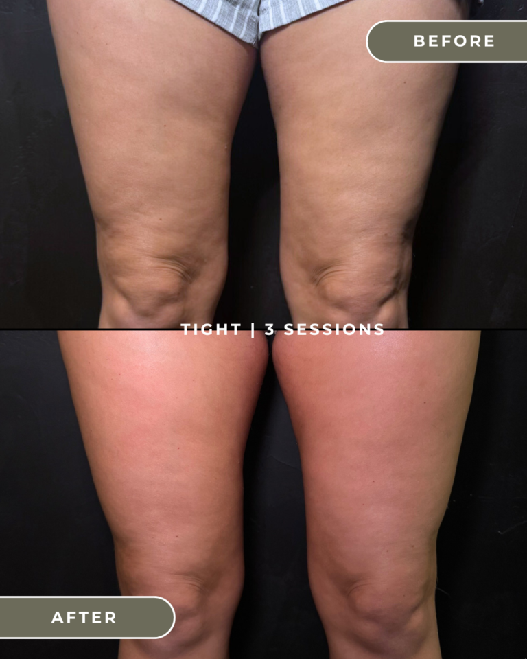 RADIOFREQUENCY SKIN TIGHTENING ORANGE COUNTY COSTA MESA
