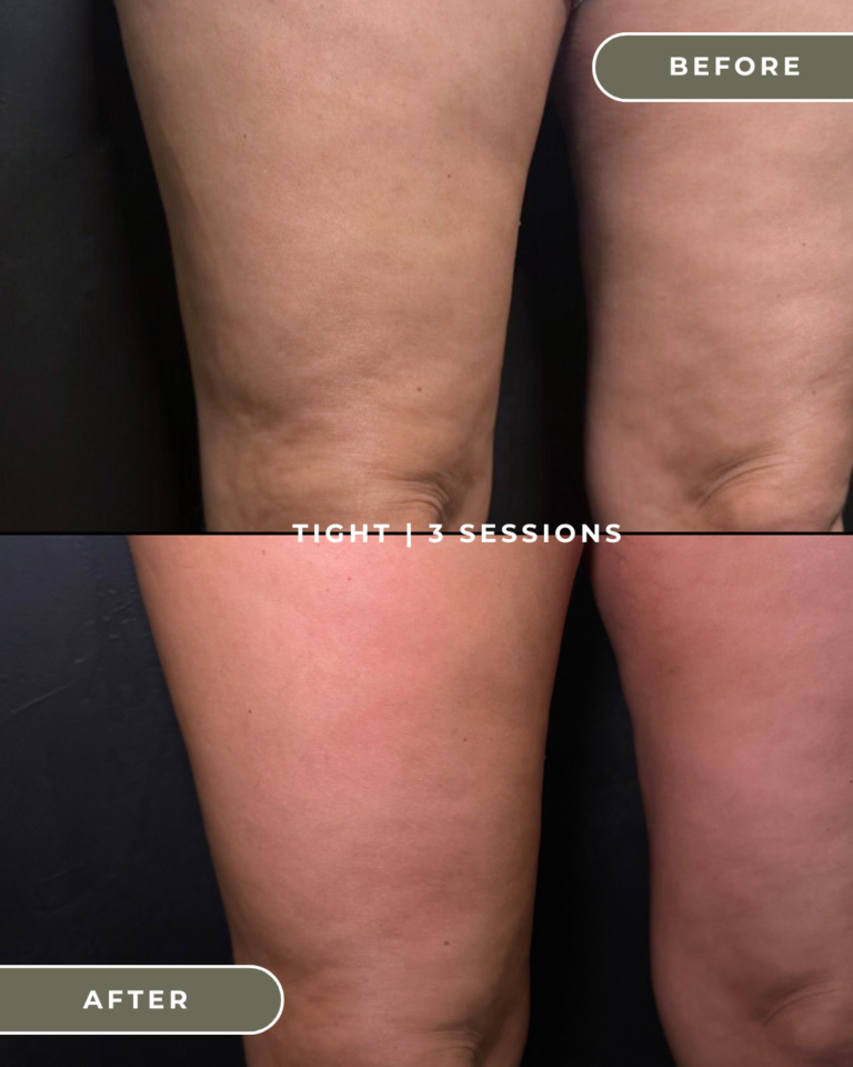 SKIN TIGHTENING COSTA MESA