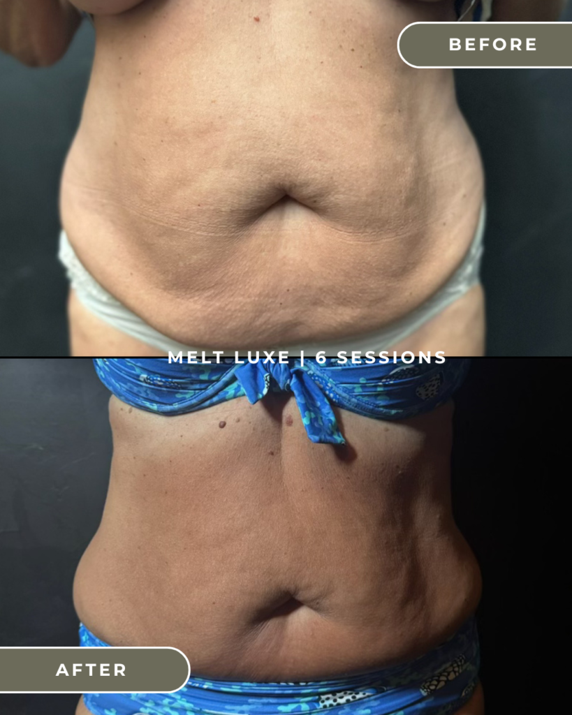 BODY SCULPTING COSTA MESA ORANGE COUNTY