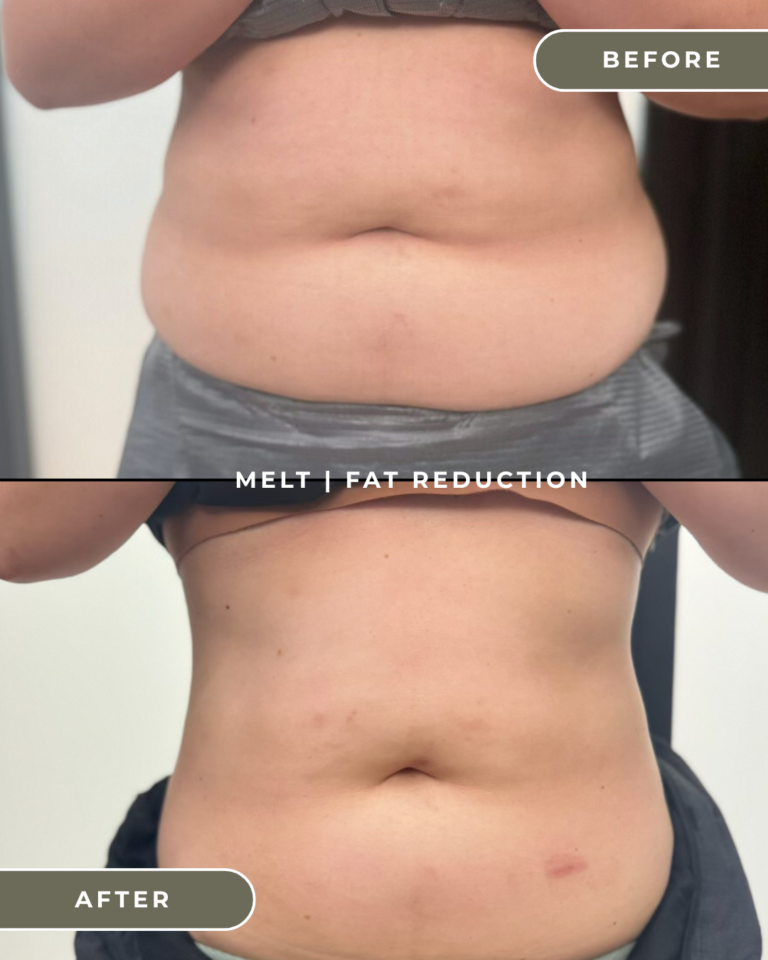FAT REDUCTION CAVITATION COSTA MESA ORANGE COUNTY BODY SCULPTING
