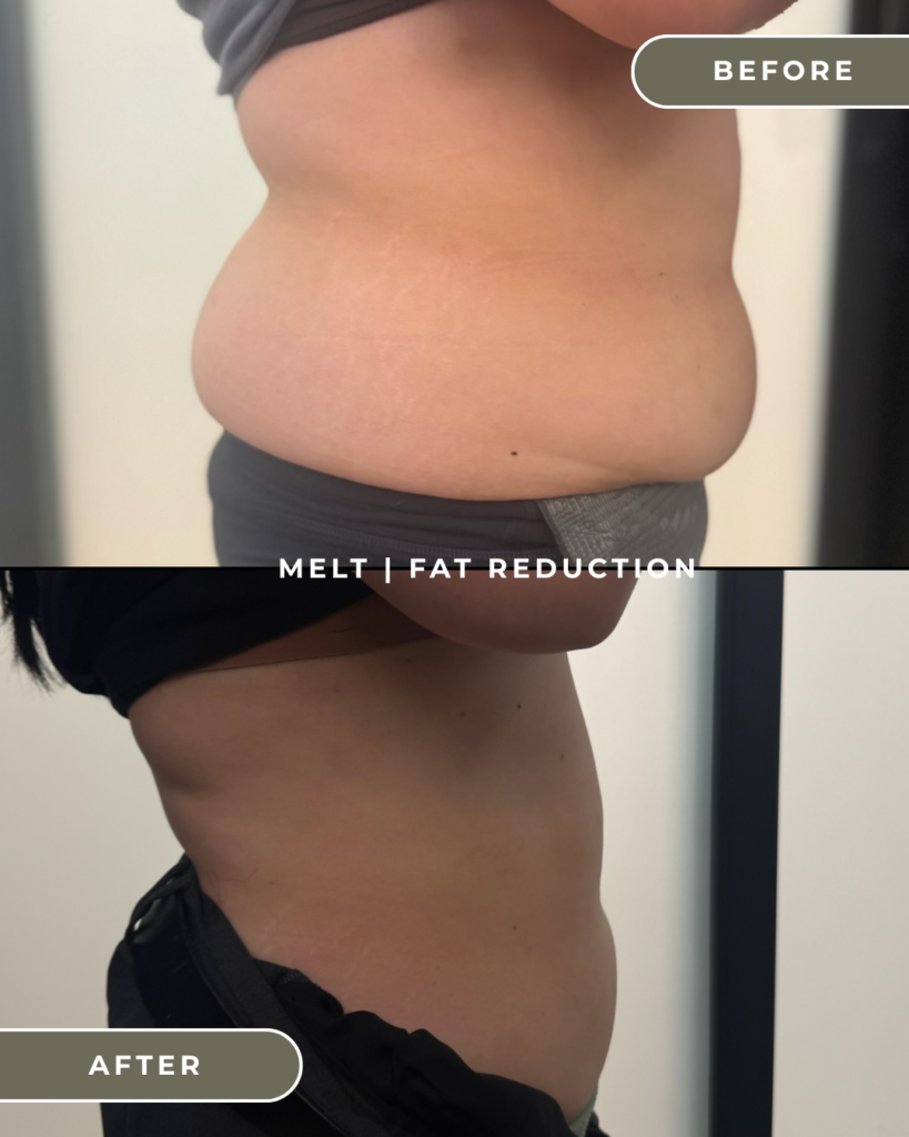FAT REDUCTION CAVITATION COSTA MESA ORANGE COUNTY
