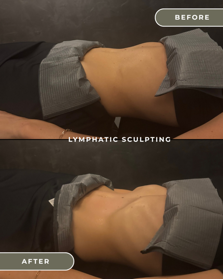 LYMPHATIC DRAINAGE COSTA MESA