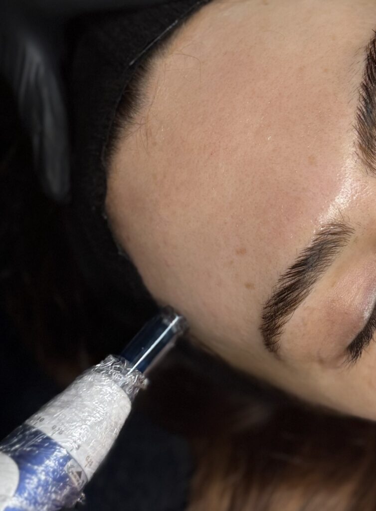 microneedling costa mesa newport