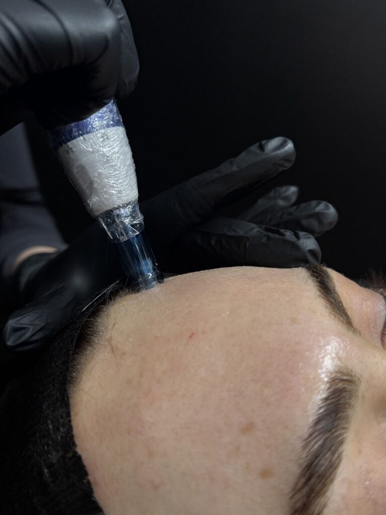 microneedling costa mesa
