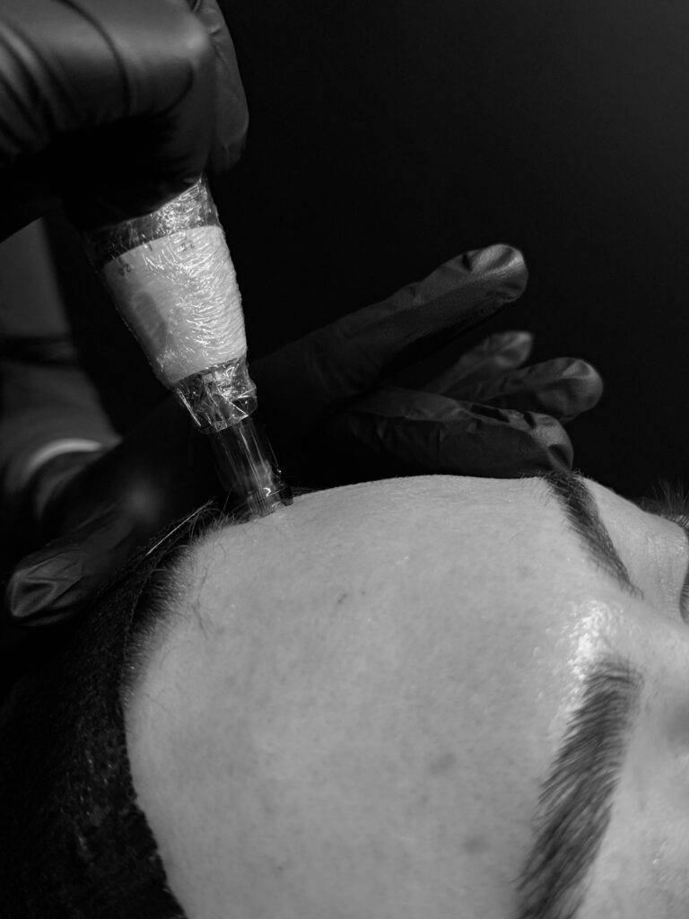 microneedling orange county costa mesa